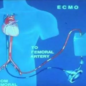 答案来了!加拿大白求恩医学发展协会为什么要捐ECMO(人工心肺机)及耗材